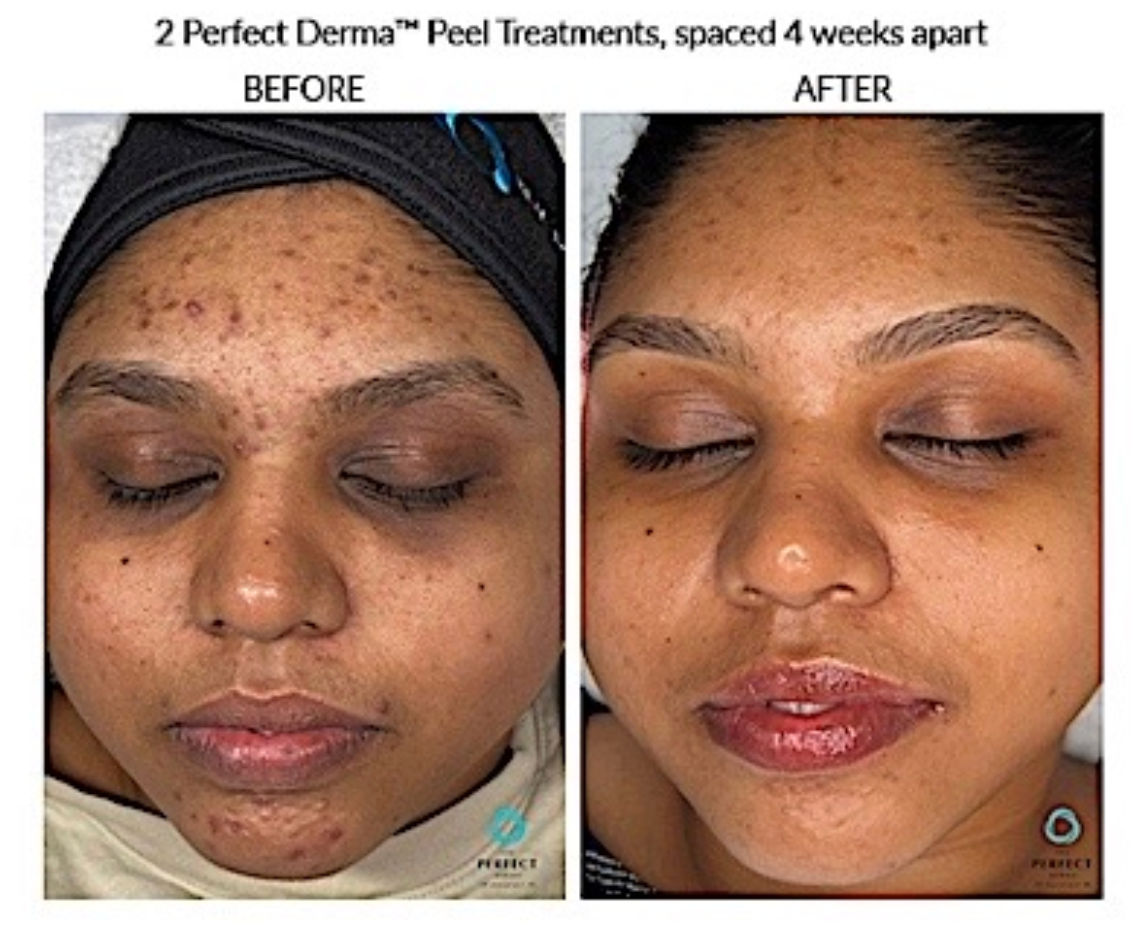 Perfect Derma Peel - Package of 3