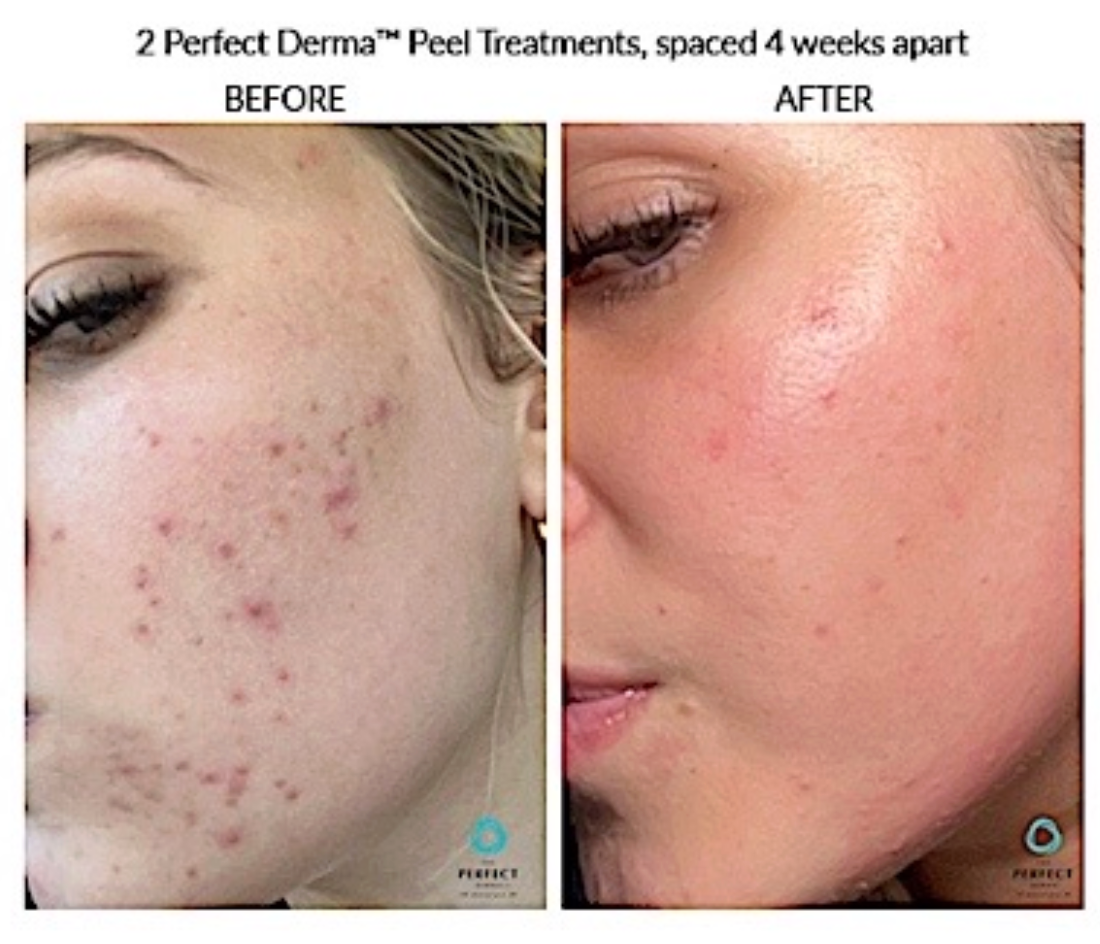 Perfect Derma Peel - Package of 3