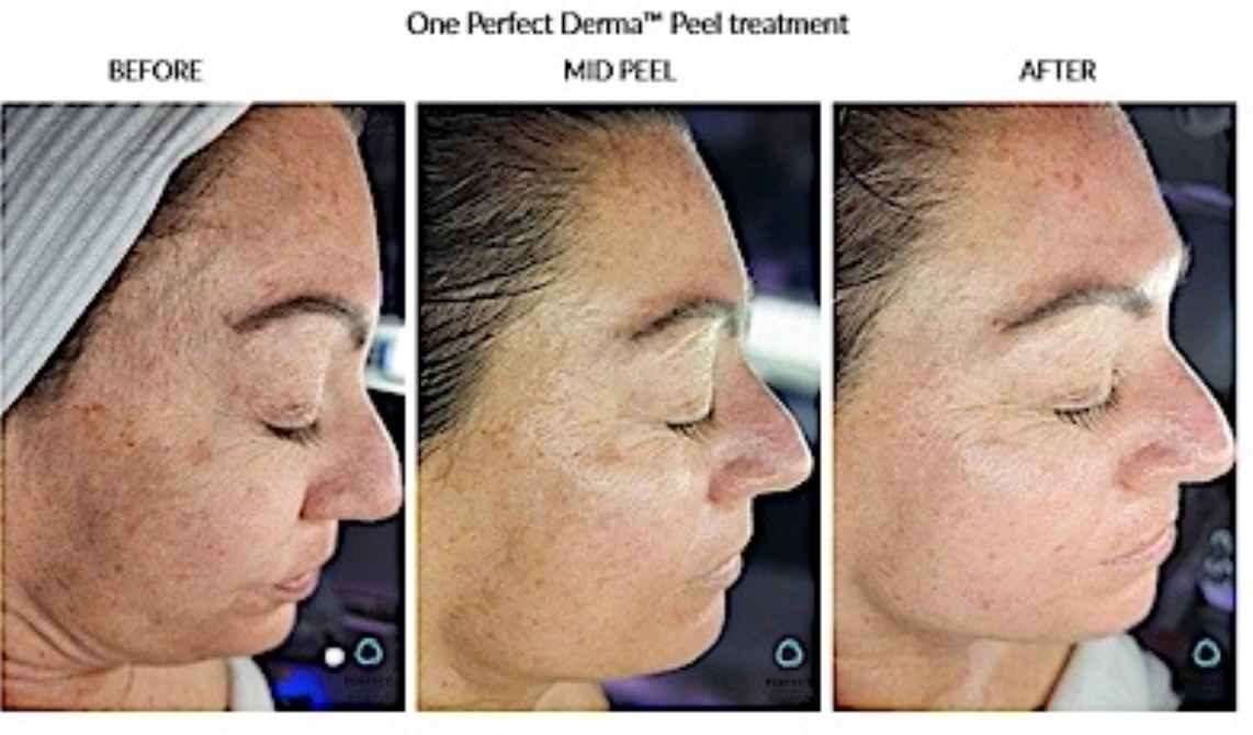 Perfect Derma Peel - Package of 3