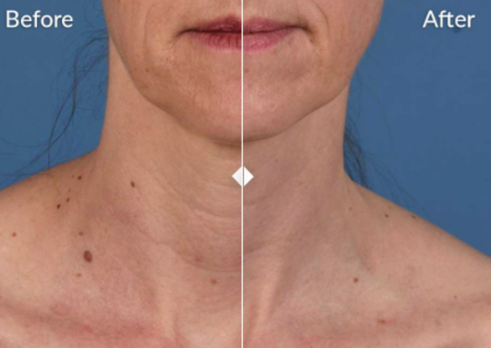 SkinPen Microneedling (FACE & NECK) - Package of 3